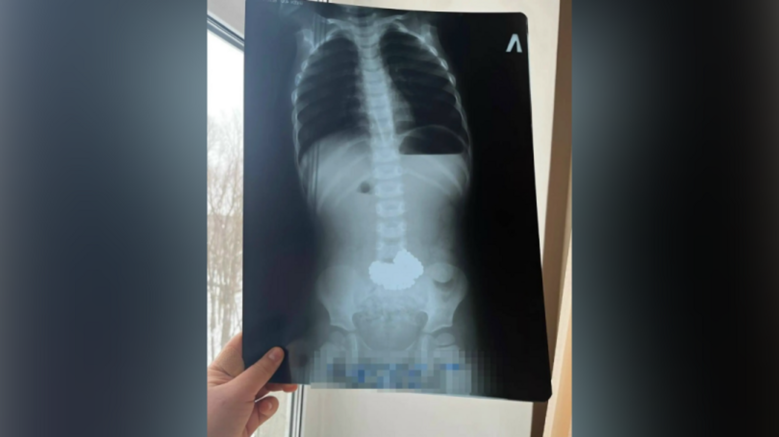 В Башкирии трёхлетний ребёнок проглотил 206 магнитных шариков