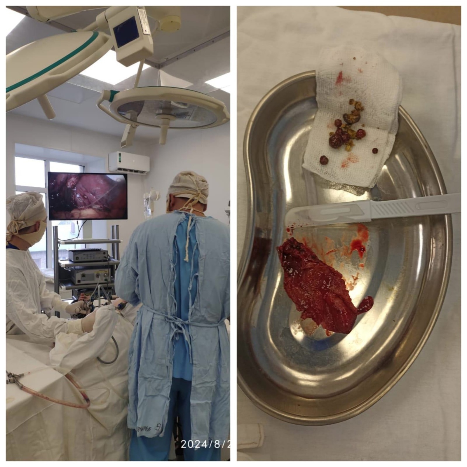 Житель Башкирии едва не погиб от разрыва пищевода