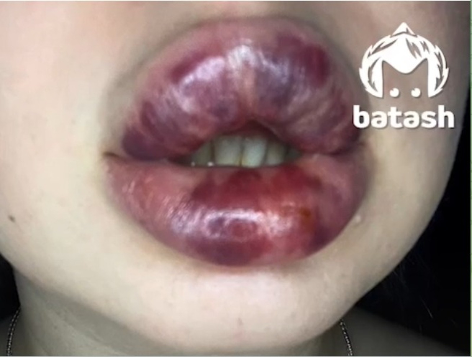 Жительнице Башкирии в клинике изуродовали губы