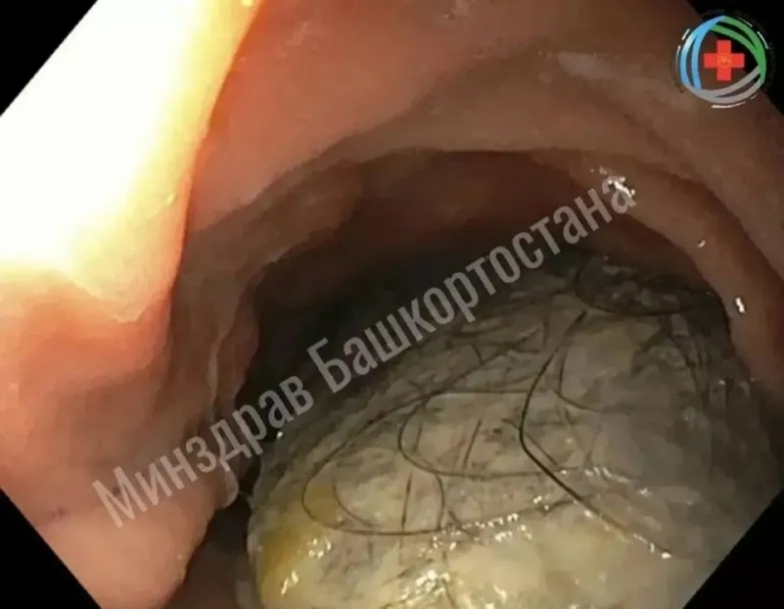 В Башкирии врачи извлекли из желудка девушки огромный комок волос